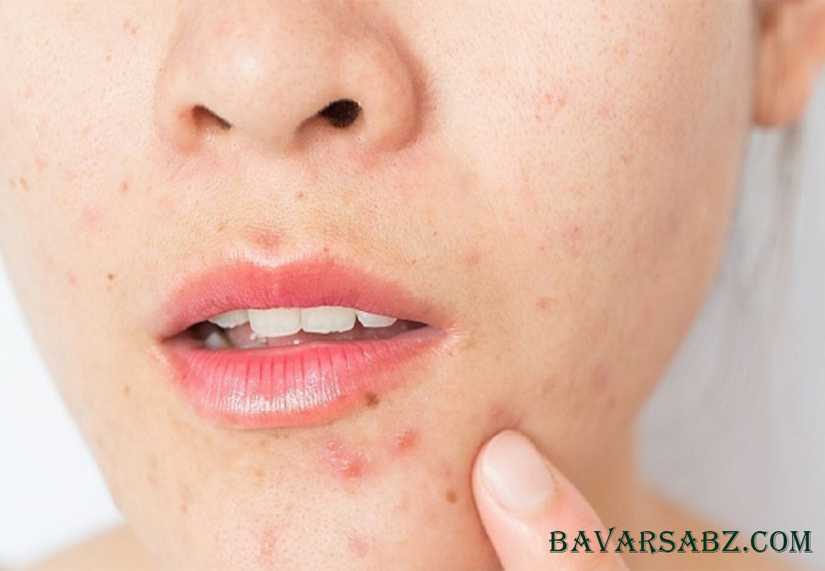 پاکسازی پوست و کاهش جوش‌ها